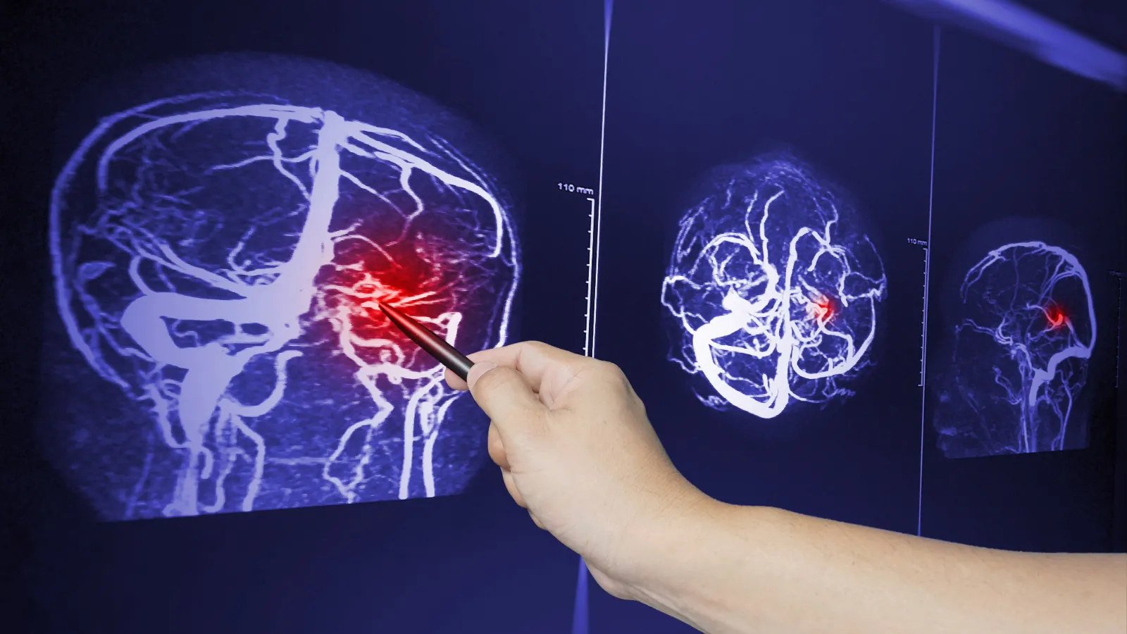 MRA brian scan image of a recent traumatic brain injury patient